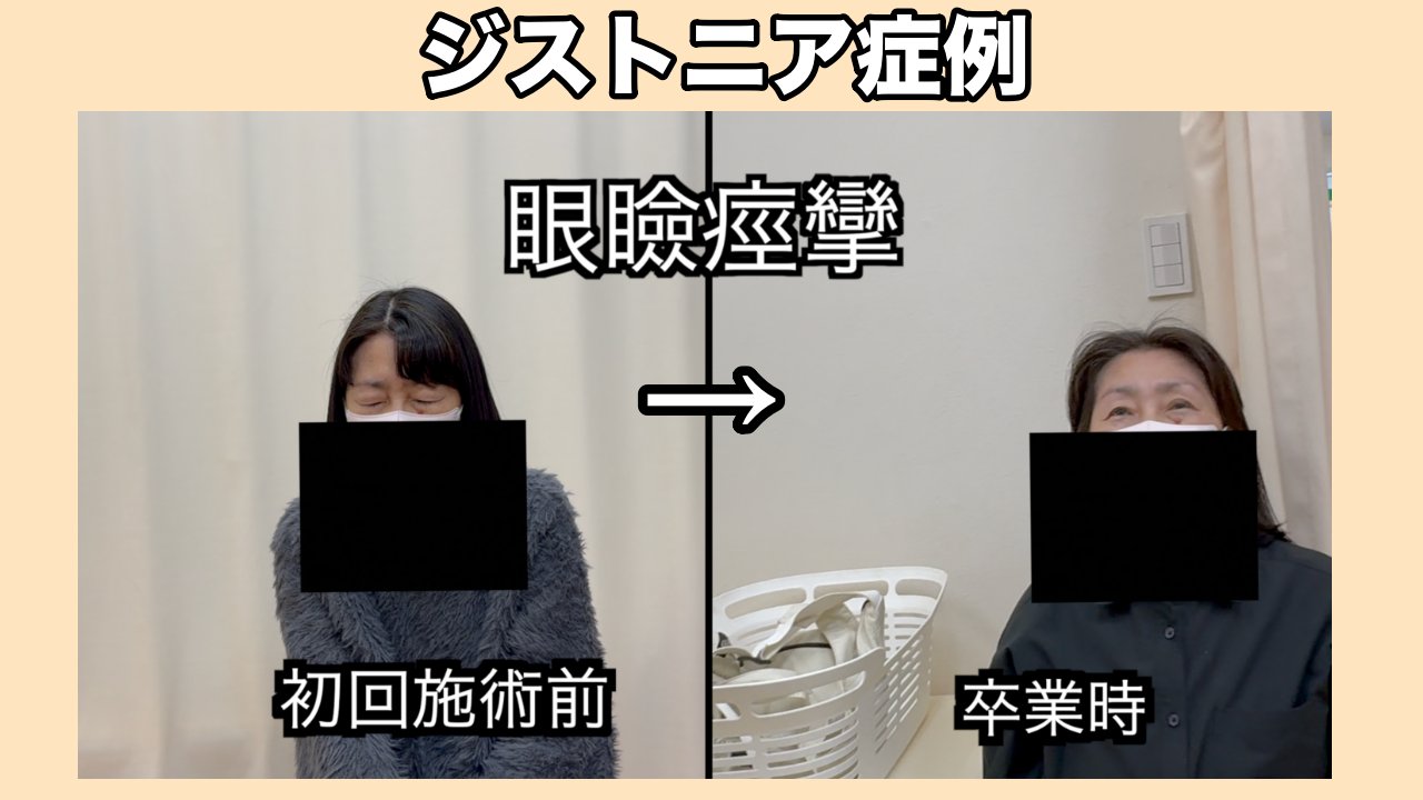 眼瞼痙攣　ジストニア